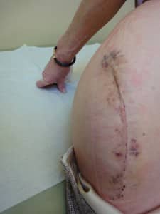 hip replacement op hip replacement op